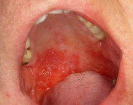 Fungal stomatitis