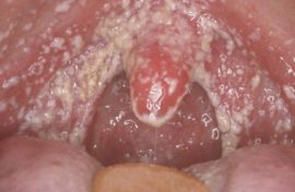 Fungal stomatitis