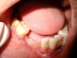 Ang talamak na odontogenikong osteomyelitis ng mas mababang panga