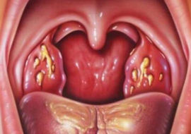 Chronická tonzilitida s hnisavými zátkami