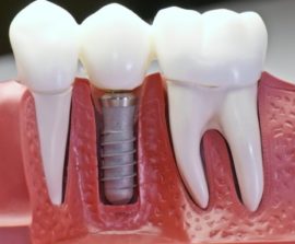 Ngipin implant