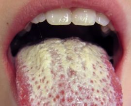 Candidiasis