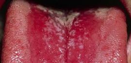 Candidiasis glossitis