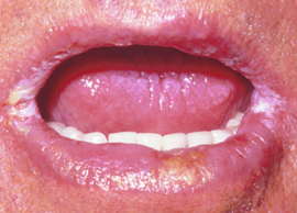 Candidiasis cheilitis