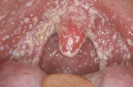 Candidiasis stomatitis