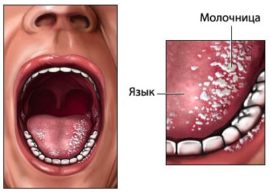 Stomatite à candidose