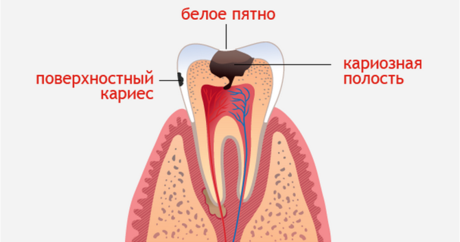 Caries