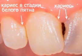 Caries aux stades initial et intermédiaire