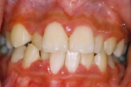 Catarrhal gingivitis