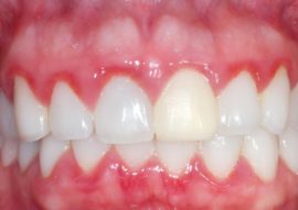 Catarrhal gingivitis