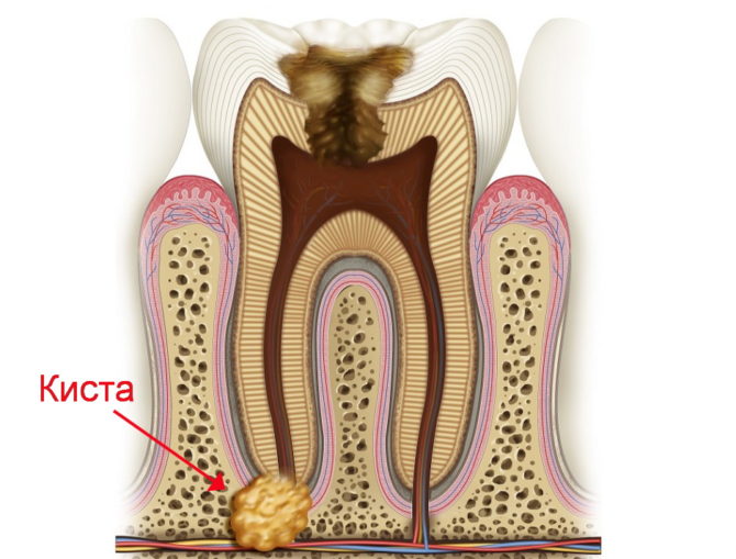 Kyste à la racine de la dent