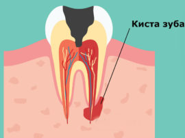 Cysta u kořene zubu