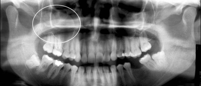 Kyste du sinus maxillaire dans l'image