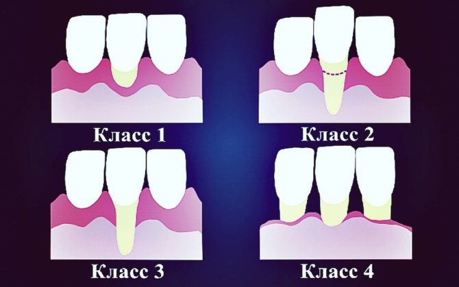 Classes de récession des gencives