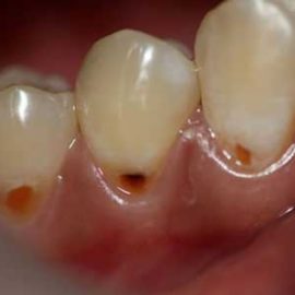 Défaut en forme de coin sur les dents