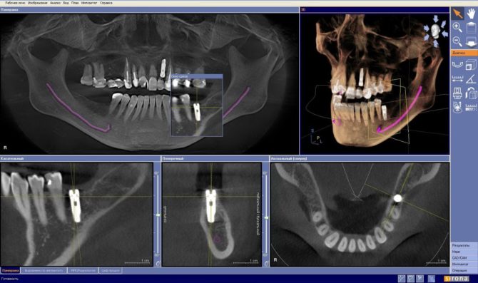 Computed tomography ng mga ngipin