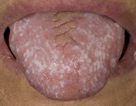 Lichen planus