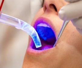 Blanchiment des dents au laser