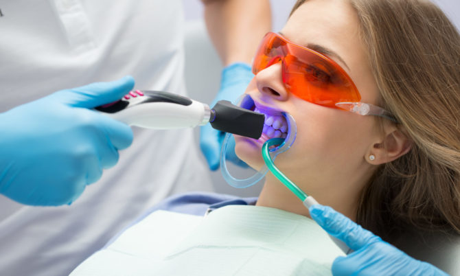 Blanchiment des dents au laser