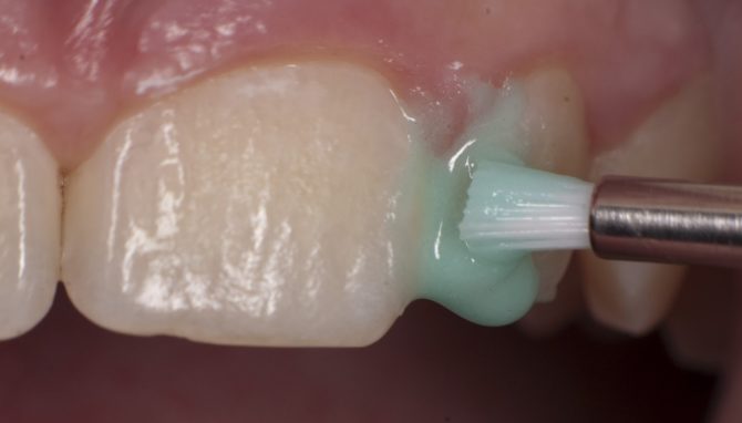 Traitement des caries à domicile