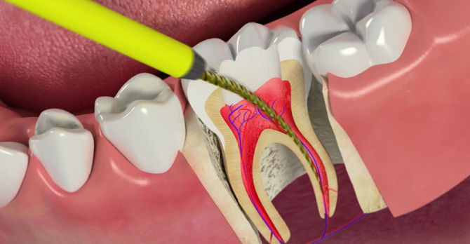 Paggamot sa Pulpitis