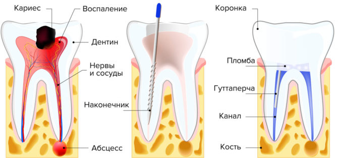 Traitement de la pulpite avec extirpation vitale