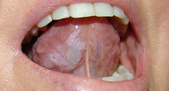 Oral Leukoplakia