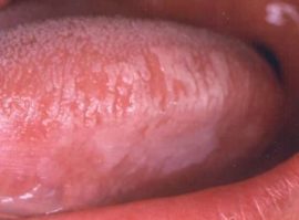 Tongue Leukoplakia