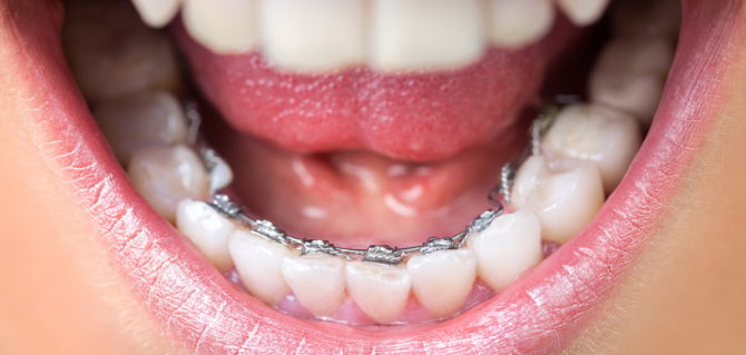 Lingual braces