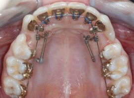 Lingual braces