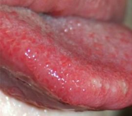 Beam glossitis