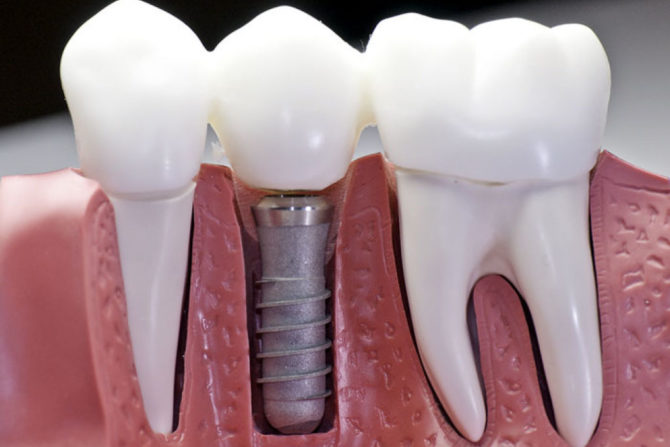 Naka-mount na implant layout