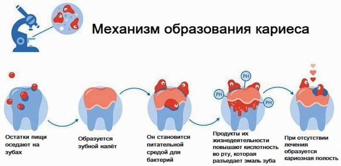 Le mécanisme de formation des caries