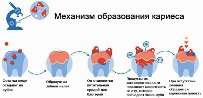 Mechanismus vzniku zubního kazu