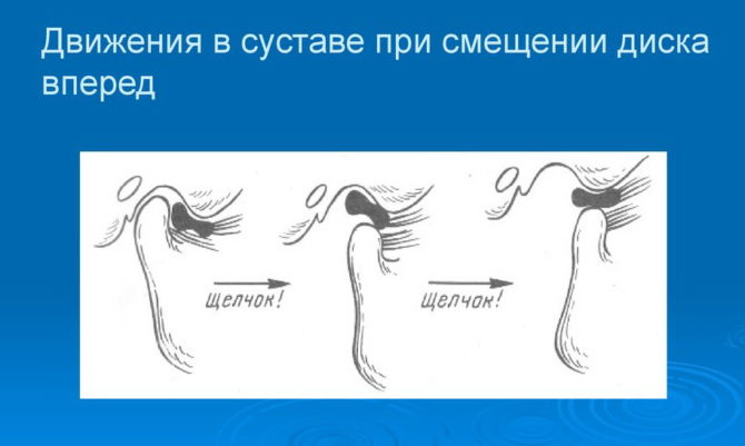 Mechanismus výskytu kliknutí v kloubu