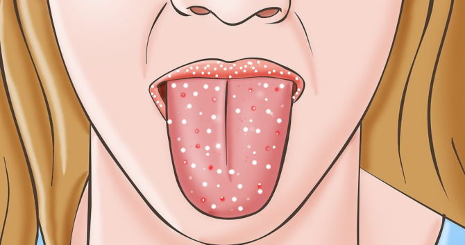 Oral thrush