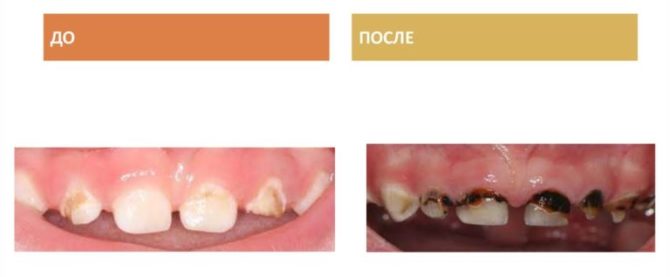 Dents de lait avant et après l'argenture