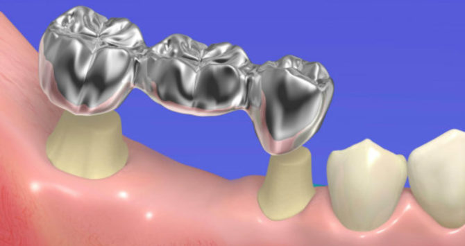 Bridge ng Wisdom Tooth