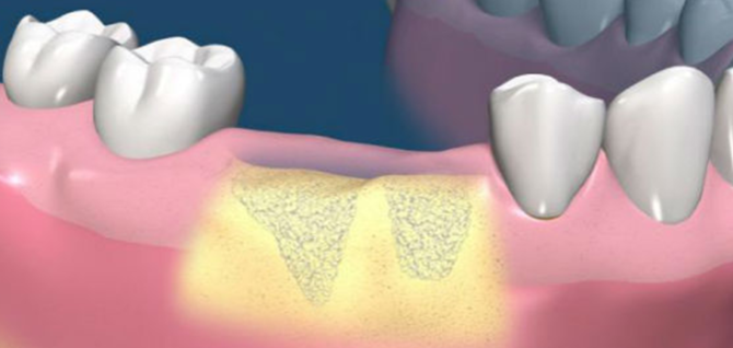 Růst kostí během implantace