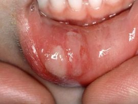 Necrotic aphthous stomatitis