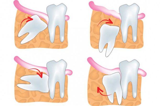 Dentition de sagesse