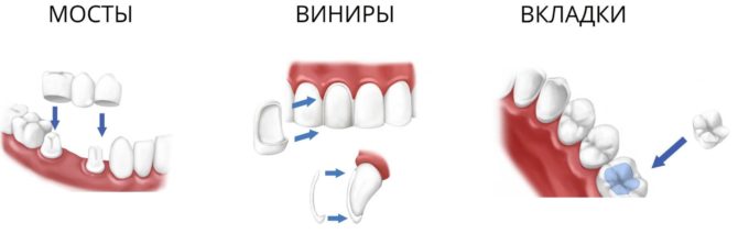 Nakapirming prosthetics