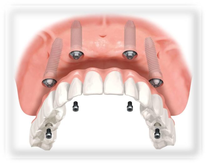 Nakapirming prosthetics