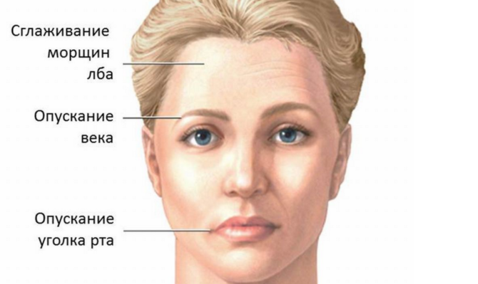 Mukha Neuralgia