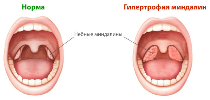 Amygdales normales et hypertrophiées