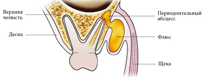 Ang pagbuo ng isang abscess sa gum