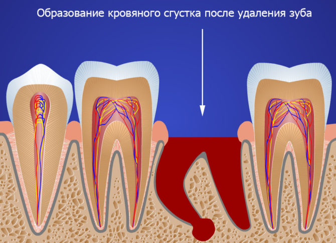 Pagkabuo ng clot ng dugo pagkatapos ng pagkuha ng ngipin