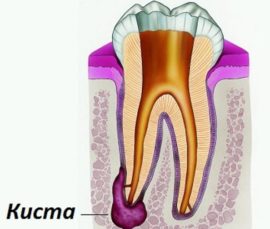 Wisdom Tooth Cyst