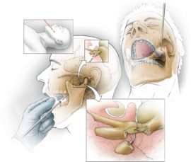 Trigeminal surgery