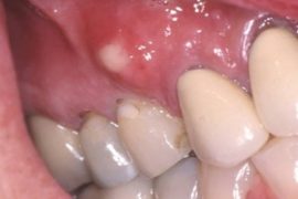 Gum tumor na may periodontitis